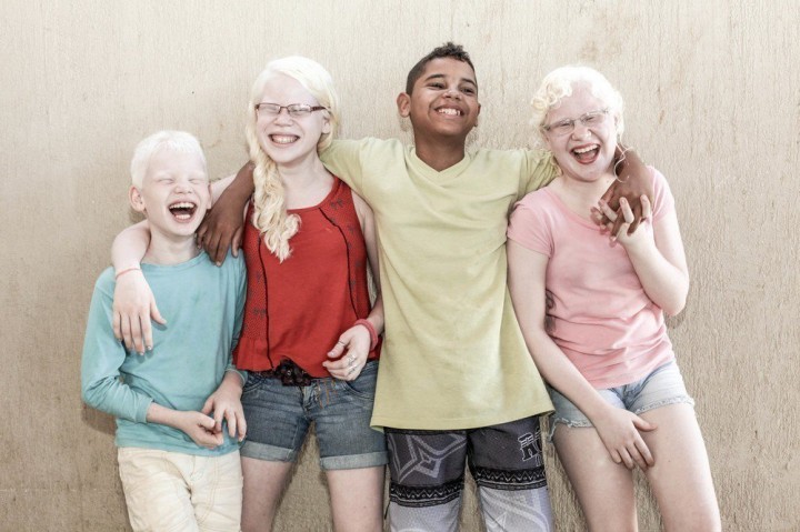 백색증(Albinism)은 멜라닌 색소의 분포와 합성 대사과정에 결함이 생겨서 출생 시부터 피부와 머리카락, 홍채에 소량의 색소를 가지거나 전혀 없는 희귀 유전질환입니다.